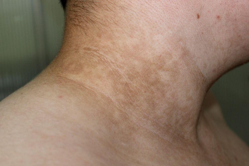 Hyper pigmentation.webp