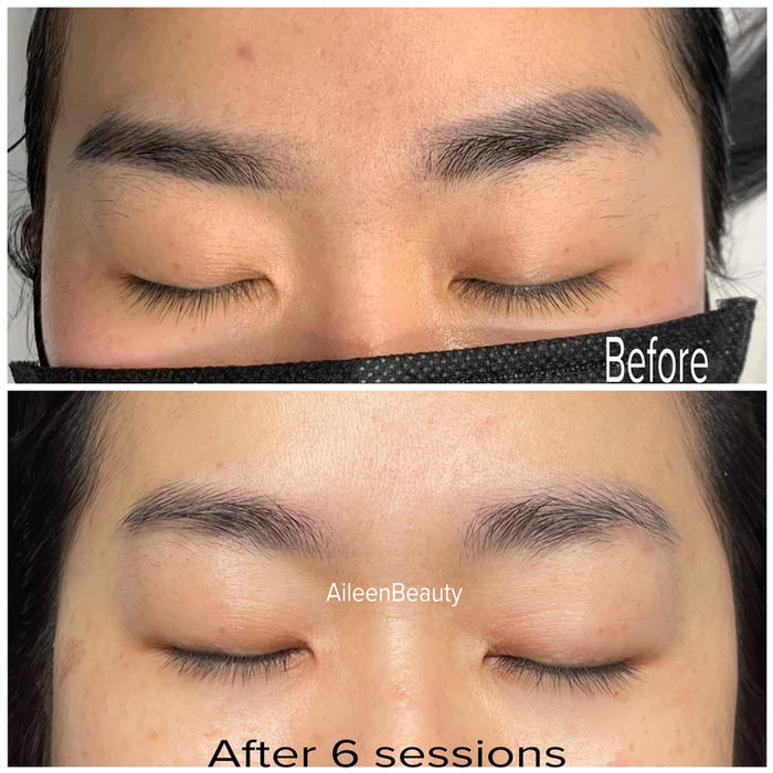 Eyebrows before and after 6 sessions at AileenBeauty