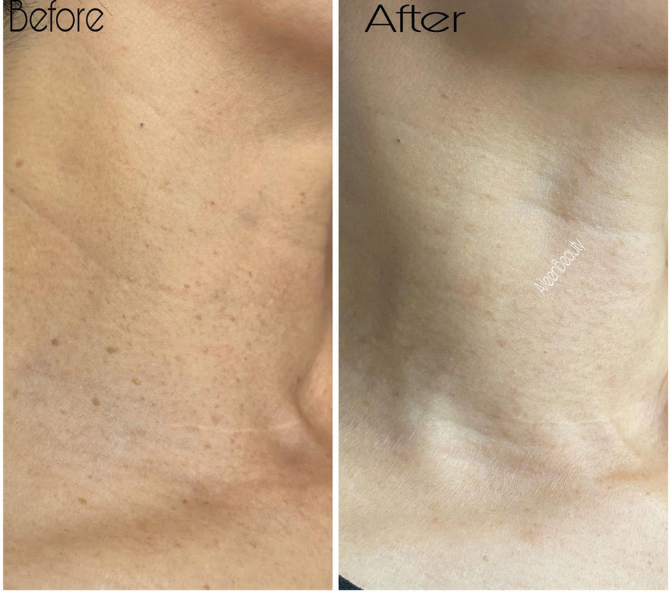 Before and after photos of a person's neck, showing improvement in wrinkles and skin tone.