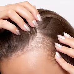 Select Female Hair Loss Treatment