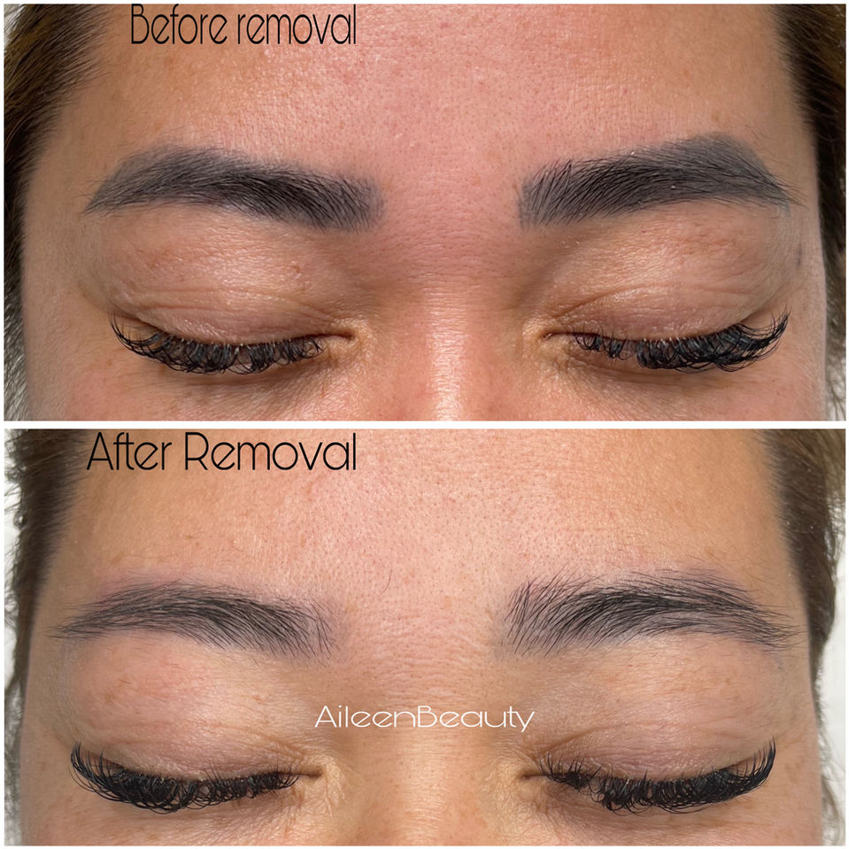 Before and after eyebrow removal, showing the results of the procedure. "Before Removal" and "After Removal" are visible in the image. AileenBeauty is also visible in the image.