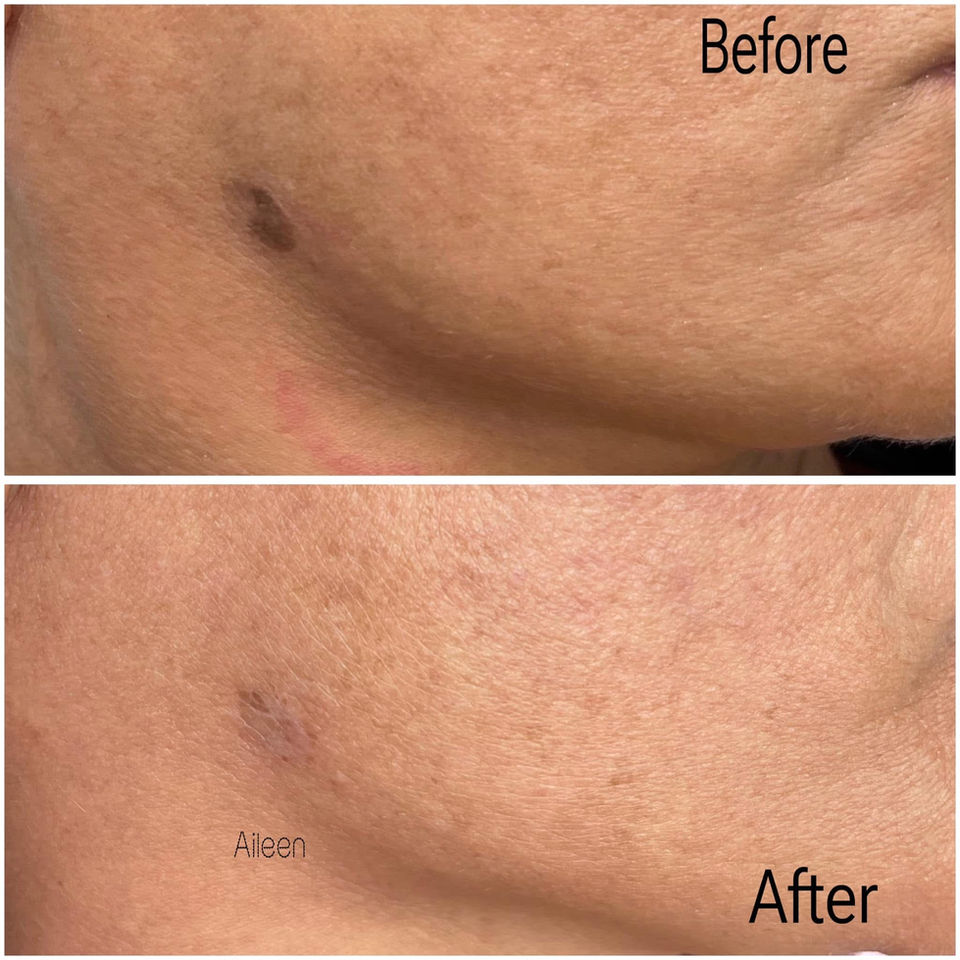 Before and after photos of Aileen's skin treatment, showing a noticeable improvement