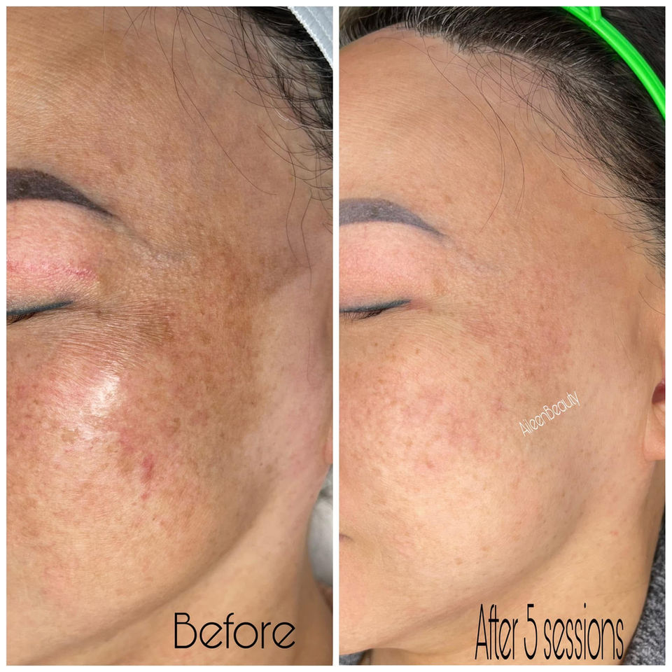 Skin before and after 5 sessions of treatment, showing improvement in tone and texture, Aileen's Beauty