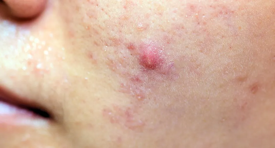 Papules-1.webp