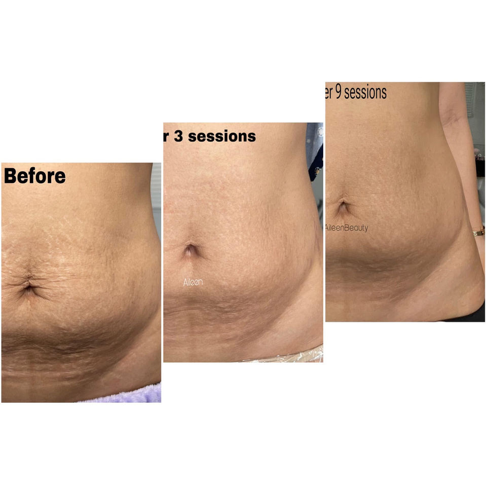 Stretch marks treatment results showing before and after images, with labels 'Before', 'After 3 sessions', and 'After 9 sessions'.