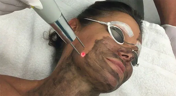 carbon_peel_blog.webp