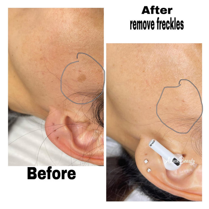 Close-up before and after photos showing freckle removal on a person's cheek, with text 'Before' and 'After remove freckles'