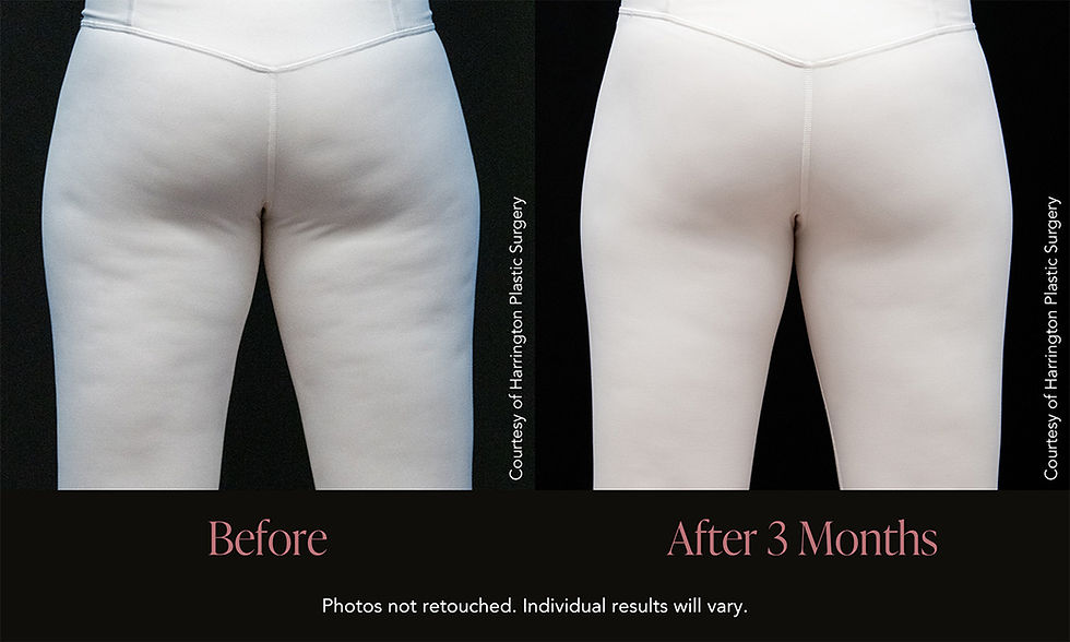 Avéli Before and After Treatment Results