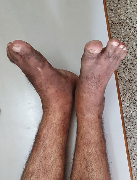 arthritis home remedy