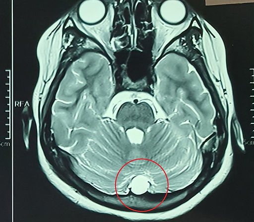 arachnoid cyst