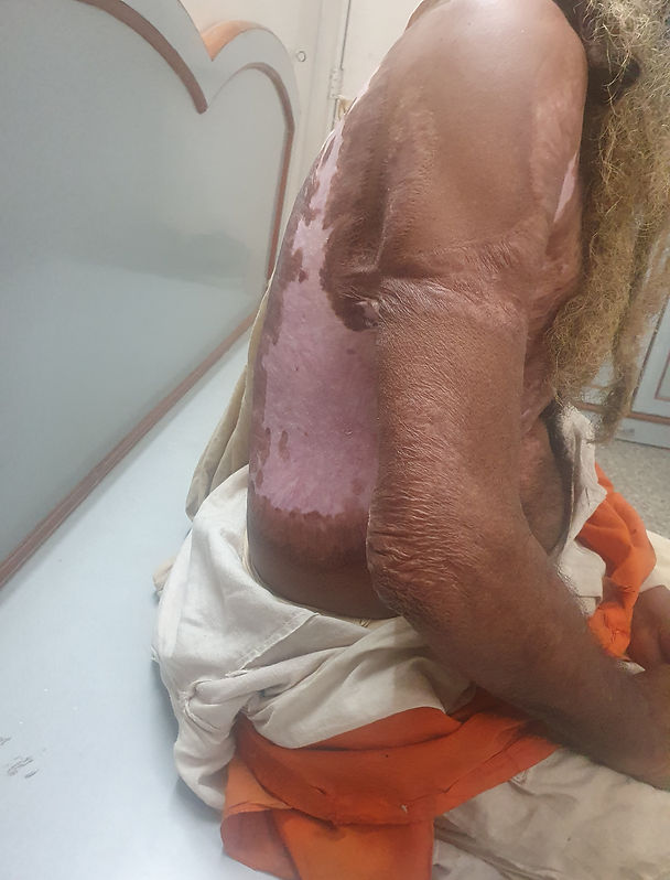 severe skin burn treatment