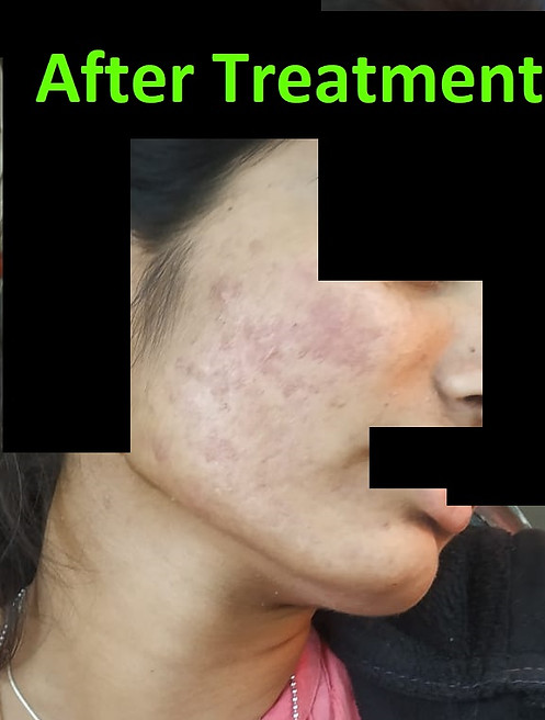 pimples treatment
