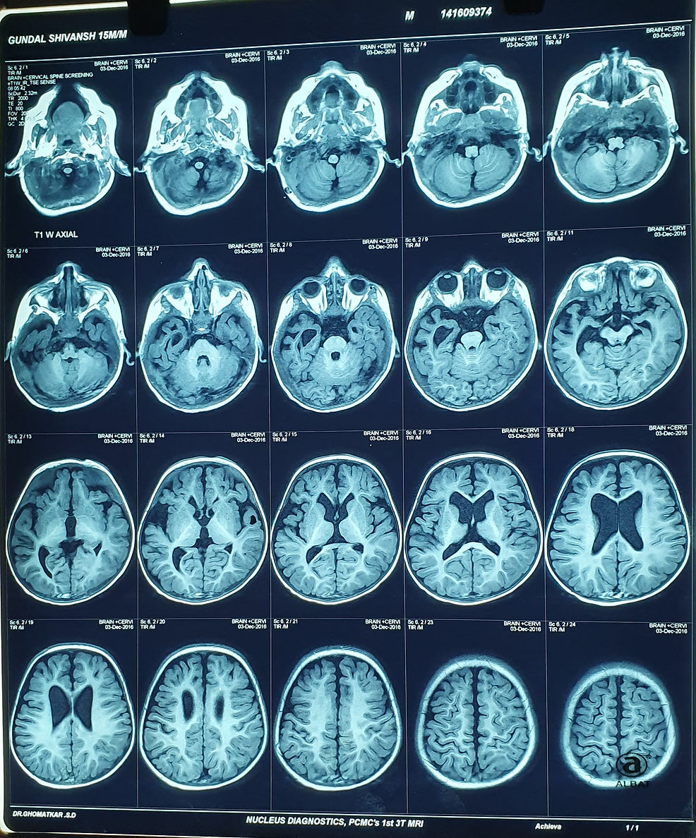 Hemangioendothelioma Treated successfully