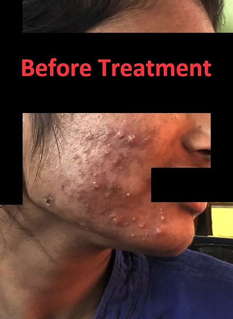 acne, acne treatment, blemish, dark circles, dark spots, skin treatment, acne problem, beauty treatments, pimple, benzoyl peroxide, blackheads, pimple cream, skin whitening, acne scars, chemical peel, pimples on face, benzoyl peroxide gel, skin clinic near me, cystic acne, adapalene gel, dark spots on face, salicylic acid face wash, clindamycin gel, home remedies for pimples, skin lightening, dark circles under eyes, acne cream, comedones, pimple treatment, skin peeling, black spots on face, skin whitening treatment, dark spot remover, black spots on skin, melasma treatment, acne scar removal, microneedling back acne, sun spots, skin tightening, skin lightening treatment, acne face wash, home remedies for acne, pimples on forehead, benzoyl peroxide face wash, best pimple cream, home remedies for dark circles, adapalene types of acne, benzoyl peroxide cream, acne scar treatment, dark circle treatment, acne rosacea, oatmeal bath, acnestar gel, pimples on back, tea tree oil for acne