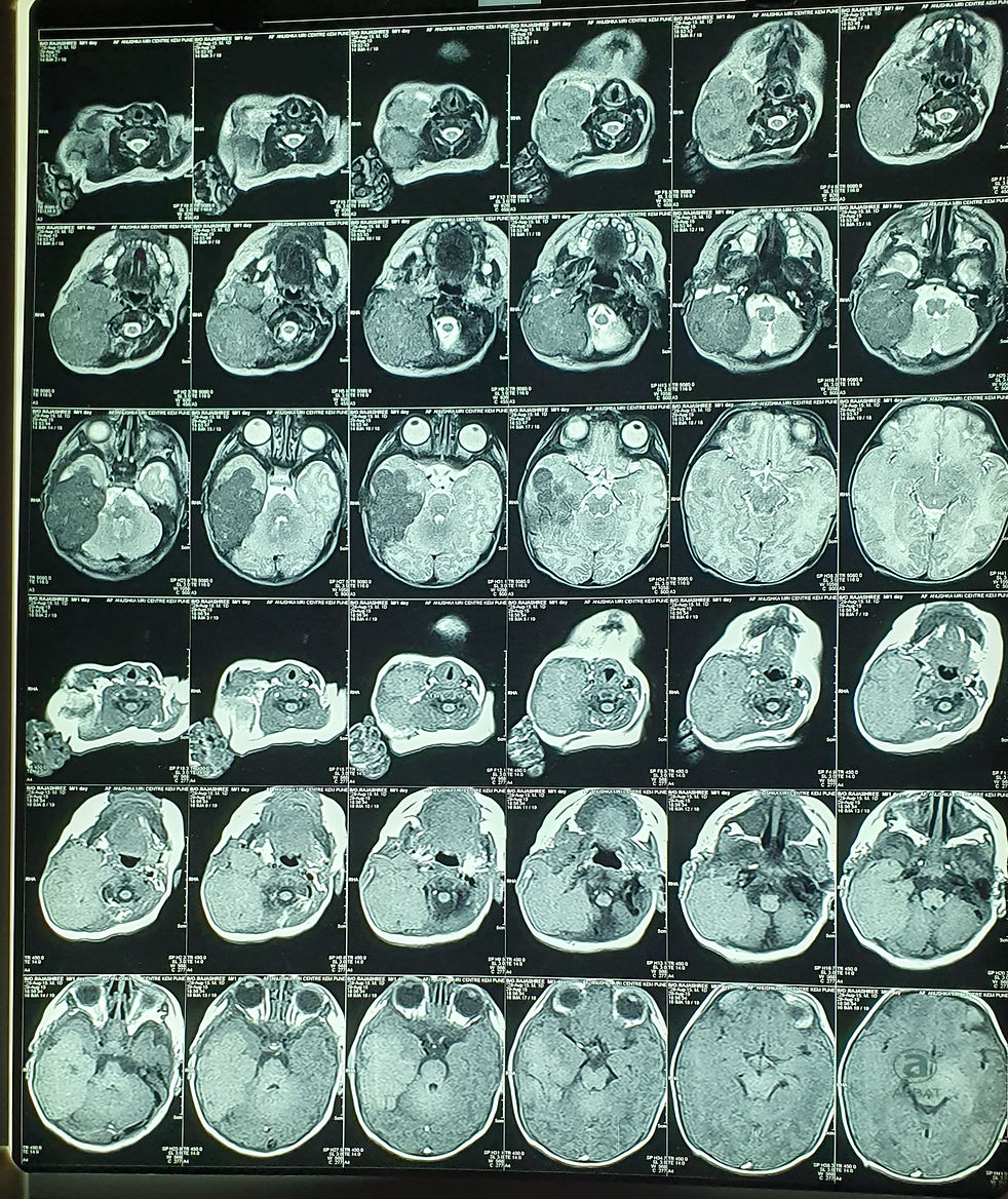 hemangioendothelioma,hemangioendothelioma treatment,hemangioendothelioma medicine ,brain tumor treatment , neurosurgeon in pune ,neuro surgeon,homeopathy medicine for brain tumor ,is brain tumor curable , causes of brain tumor , brain tumor specialist ,neurologist near me , best treatment for btain tumor , haemangioma treatment ,brain tumor before after images , mri of brain tumor ,haemangioma mri