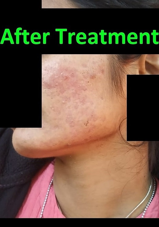 Home remedies for pimples