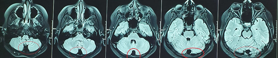 arachnoid cyst