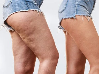 Cellulite Legs