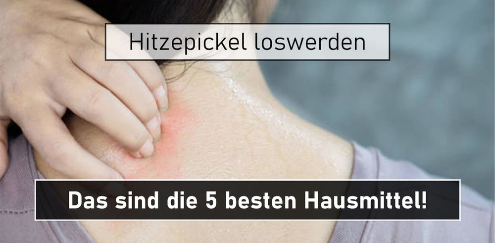 Hitzepickel loswerden mit diesen 5 Hausmitteln!