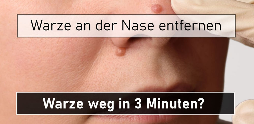 Ich Fasse An Meine Nase Warze an der Nase entfernen: Warze weg in 3 Minuten?