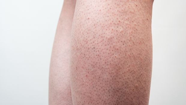 Was Kann Ich Gegen Erdbeerbeine Tun Erdbeerbeine: Die 5 besten Tipps dagegen!