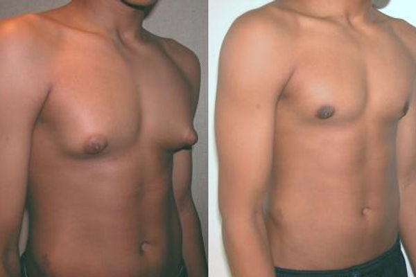 A Síndrome de Klinefelter é a anomalia cromossômica mais comum, ocorrendo em cerca de 1/500 meninos nascidos vivos. O cromossomo X extra é de origem materna em 60% dos casos. As células germinativas não sobrevivem nos testículos, causando diminuição de esperma e andrógenos. A variação clínica é grande, e muitos homens 47,XXY têm aspecto e intelecto normais.
