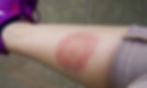 lyme bulls-eye rash