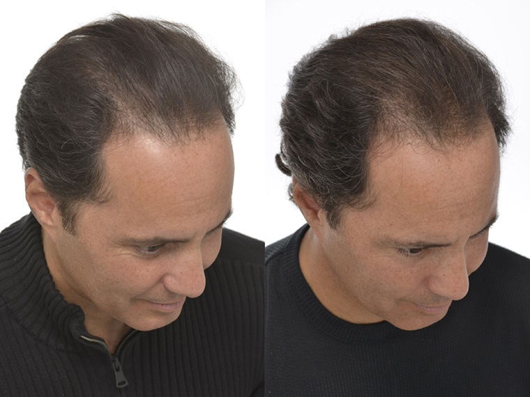 Thumbnail: Laser Hair Regrowth
