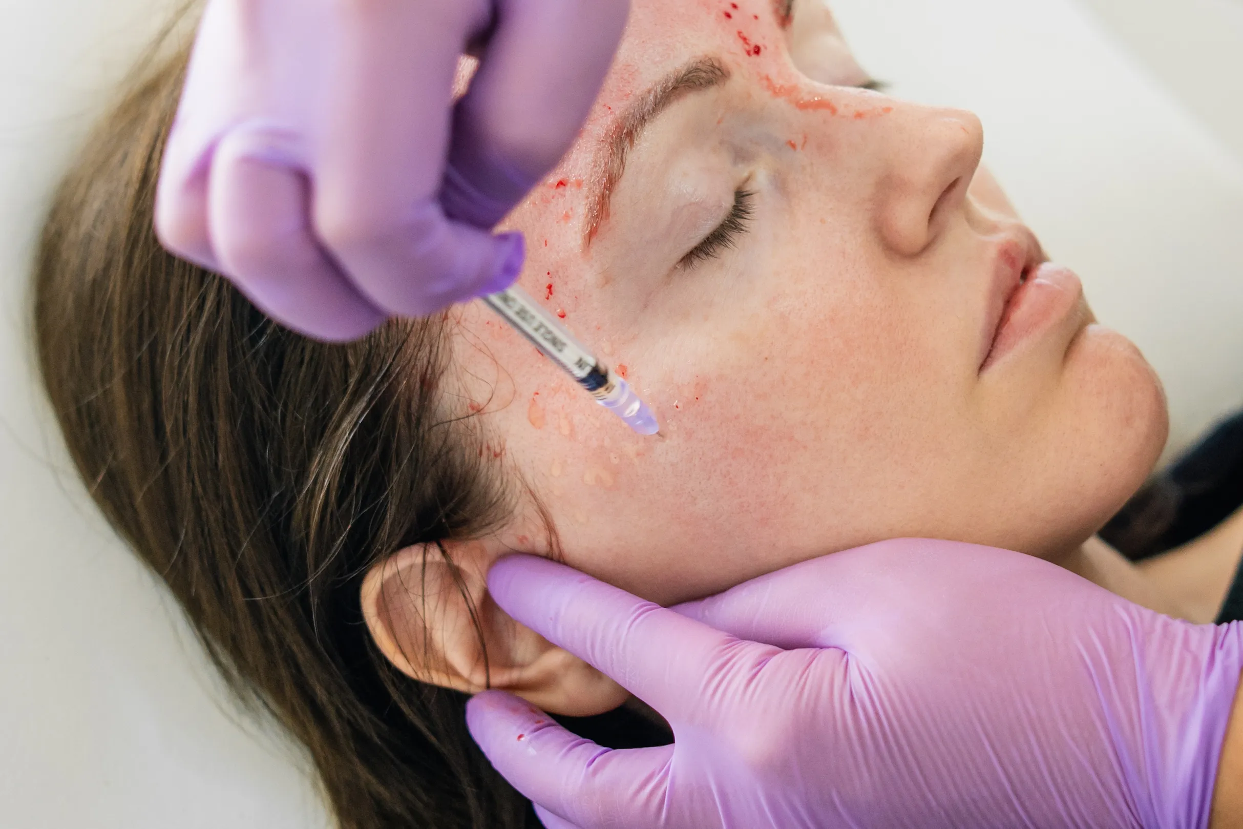 VAMPIRE FACIAL.webp