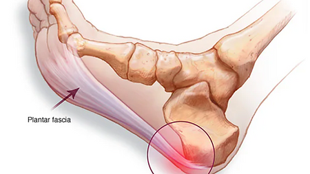 Plantar Fasciitis & Achilles Tendonitis Exercises