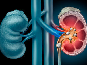 Cálculo Renal: O Que Você Precisa Saber Sobre Pedras nos Rins