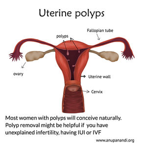Can polyps in the womb stop me getting pregnant?