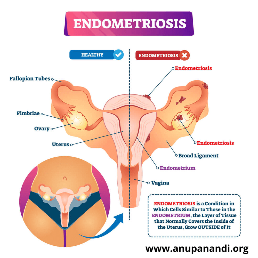 Can Endometriosis cause infertility?