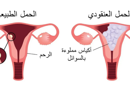 الحمل العنقودي