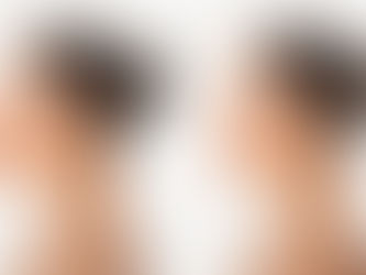 Rinoplastia Híbrida