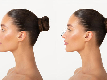 Rinoplastia Híbrida
