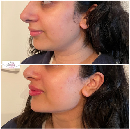 4ML Filler Package