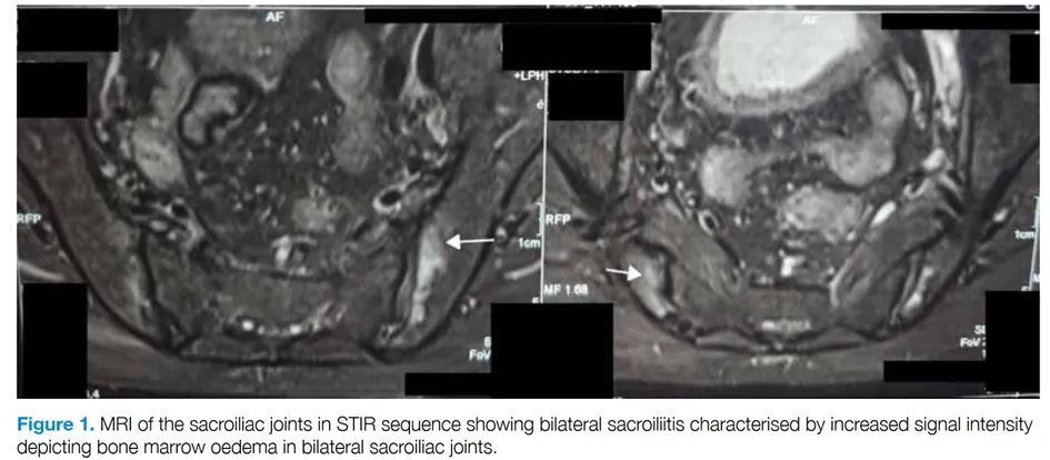 MRI of the sacroiliac joints in STIR sequence showing bilateral sacroiliitis characterised by increased signal intensity depicting bone marrow oedema in bilateral sacroiliac joints.