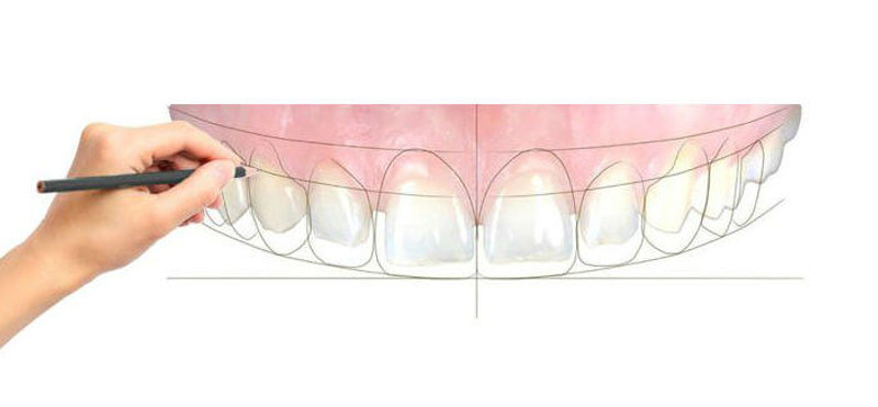 Digital-Smile-Design-1.jpg
