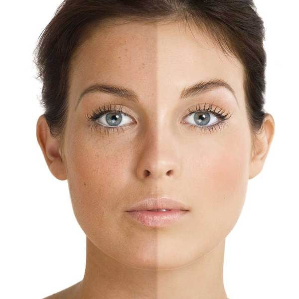 HOW EXCESSIVE SUN EXPOSURE DAMAGES THE SKIN?