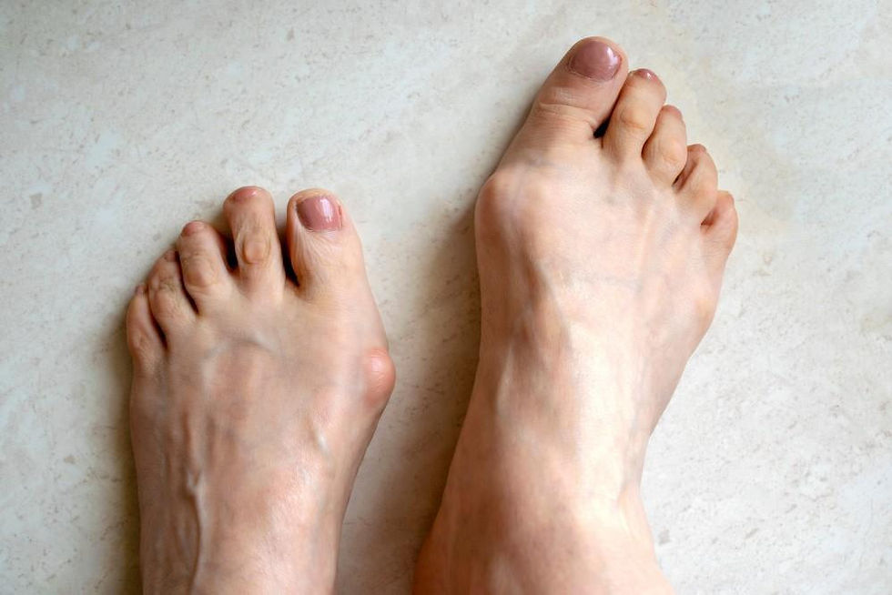 Ho l’Hallux Valgus – cosa può fare Diawin per me?