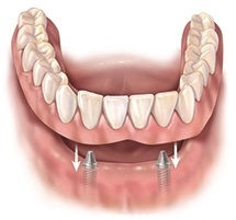 protez na implantatah