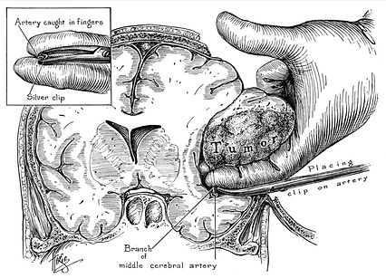 neurocirurgia do seculo passado retirando tumor cerebral com o dedo