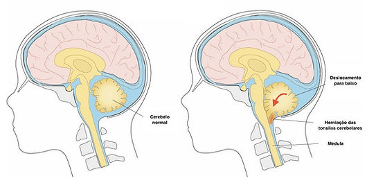 Tonsilas cerebelares na má formaçao de Chiari tipo 1