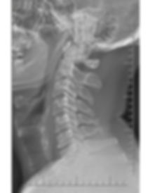 rx radiografia de coluna cervical normal