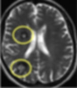 ressonancia magnetica de cavernomas cerebrais multiplos