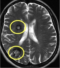 ressonancia magnetica de cavernomas cerebrais multiplos
