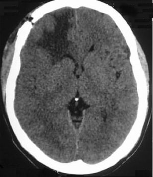 Meningioma cerebral apos cirurgia - pos operatorio