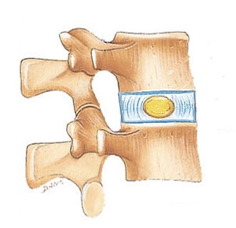 disco intervertebral normal