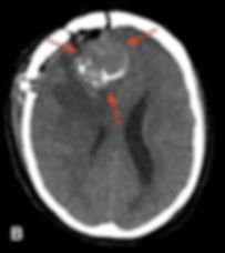 ressonancia de meningioma pos operatorio